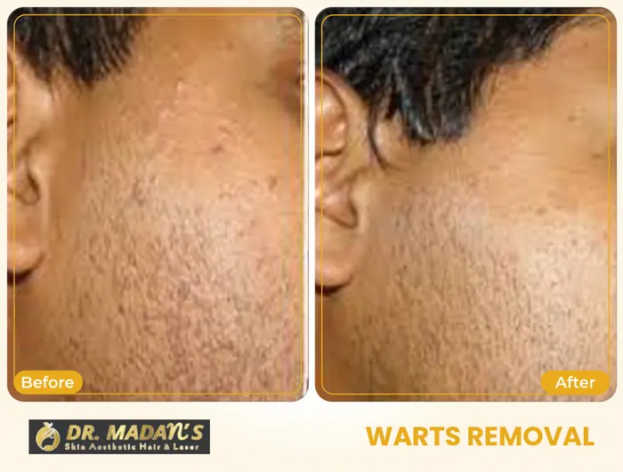 Warts removal before and after result 6 at Dr Madan Aesthetics